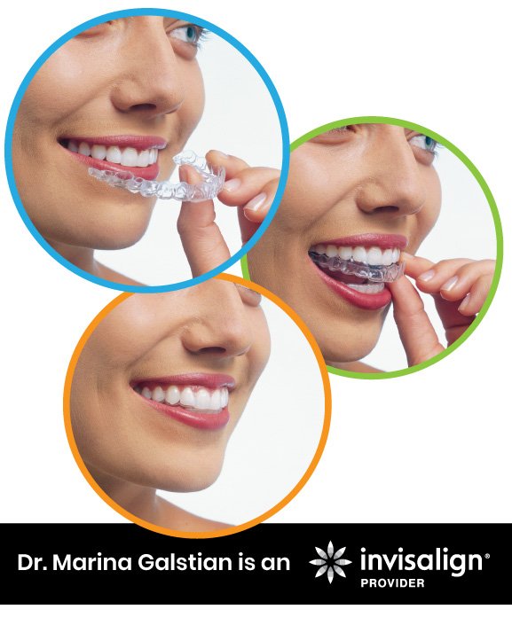 Invisalign